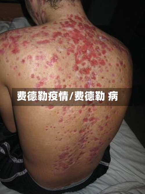 费德勒疫情/费德勒 病