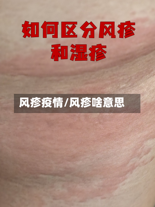 风疹疫情/风疹啥意思